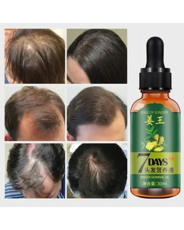 Aichun Beauty 7 Days King of Ginger Hair Growth Oil – Rapid Regrowth &amp; Fuller Hair