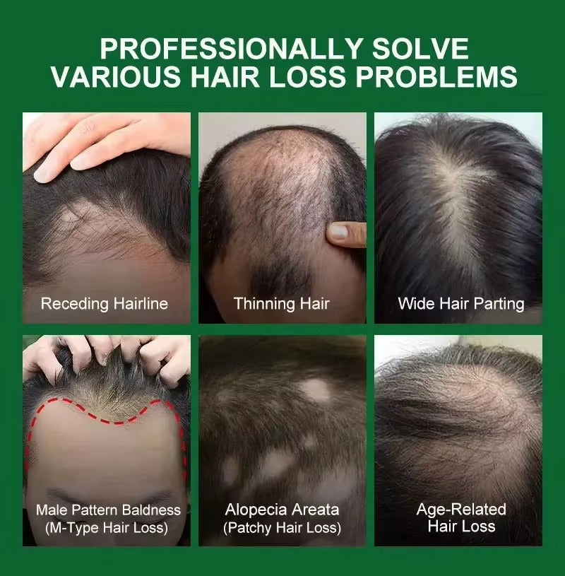 Aichun Beauty 7 Days King of Ginger Hair Growth Oil – Rapid Regrowth &amp; Fuller Hair